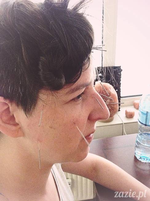 akupunktura_tradycyjna_medycyna_chinska_0h