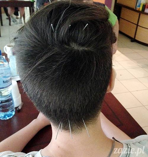 akupunktura_tradycyjna_medycyna_chinska_0i